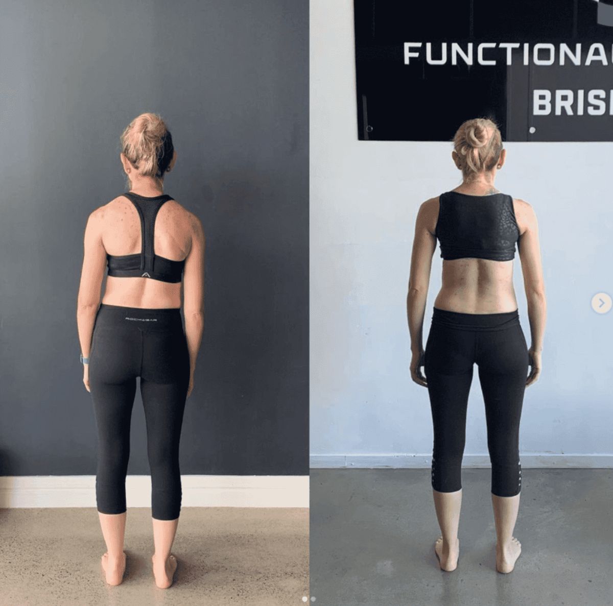 Courtney post-surgery scoliosis improvement