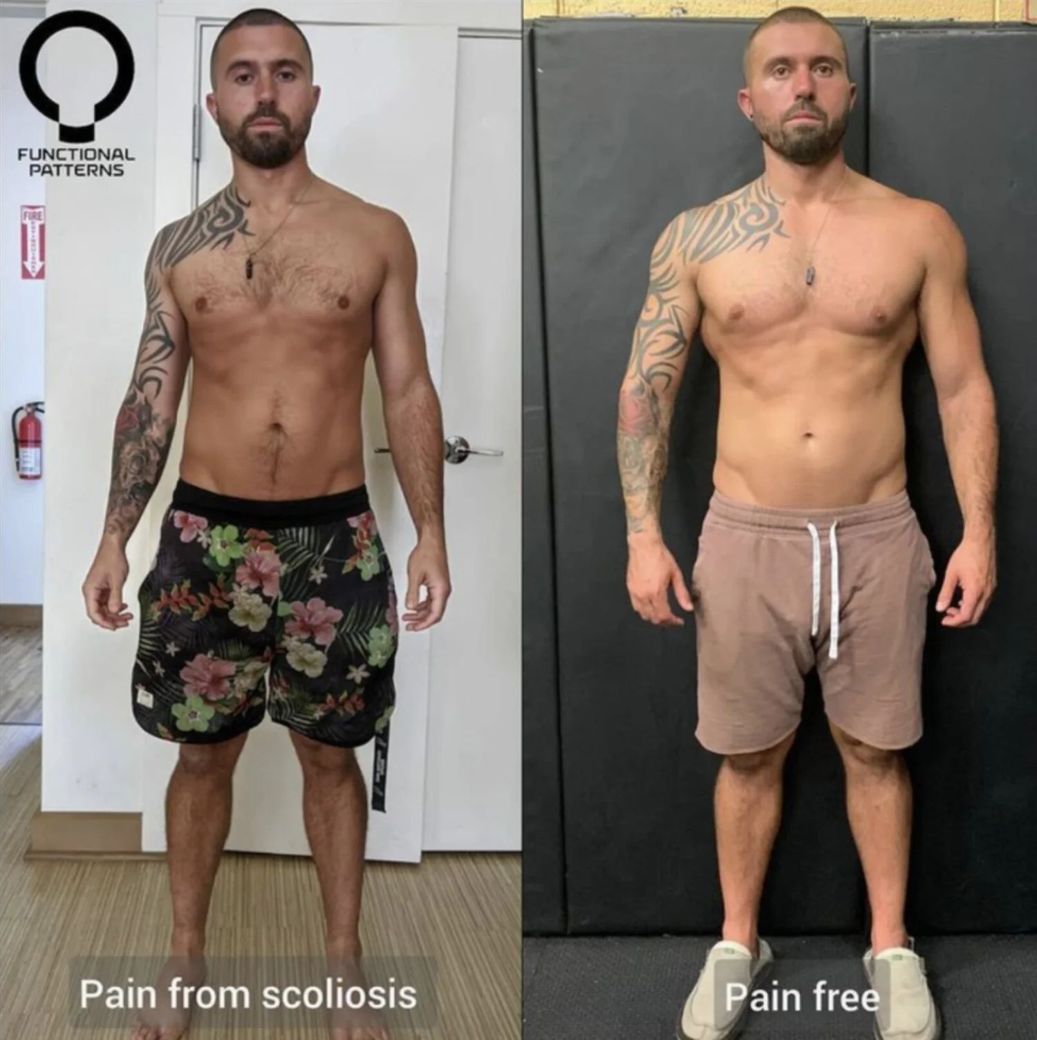 Straighten Scoliosis at Functional Patterns Brisbane