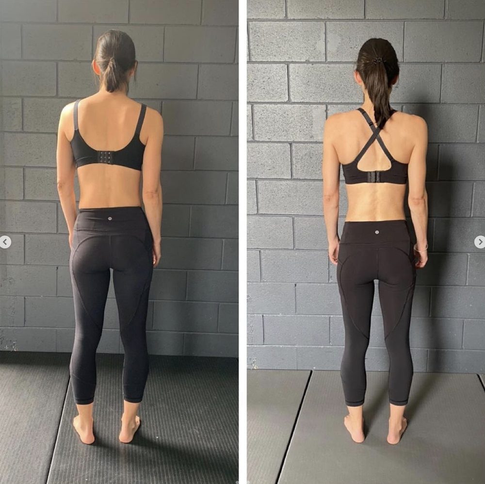 Winged shoulder blades sitting flat — back view before and after